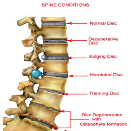 conditions of the spine